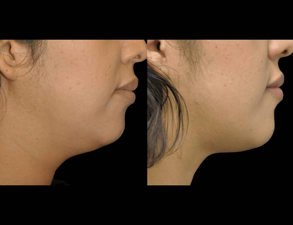 Exilis-Ultra-360™-Before-and-After-Photos-neck-1.jpg