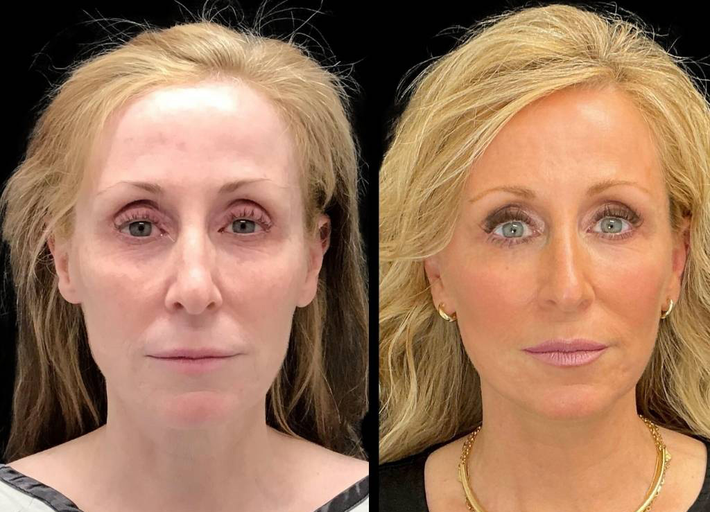 Facelift-53-yr-old-female-before-and-after-front-view.jpg