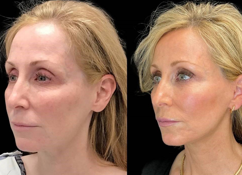 Facelift-53-yr-old-female-before-and-after-left-three-quarter-view.jpg