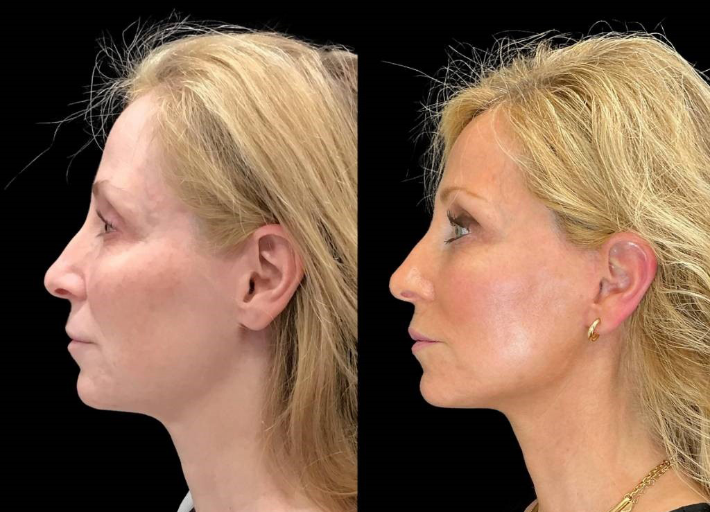 Facelift-53-yr-old-female-before-and-after-left-view.jpg