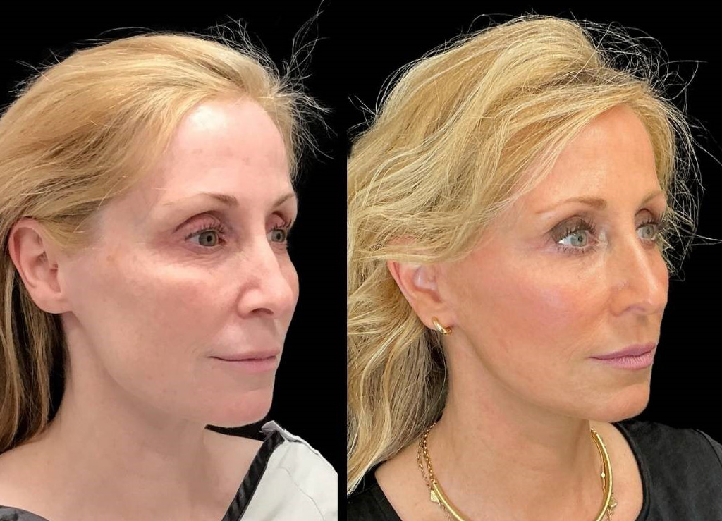 Facelift-53-yr-old-female-before-and-after-right-three-quarter-view.jpg