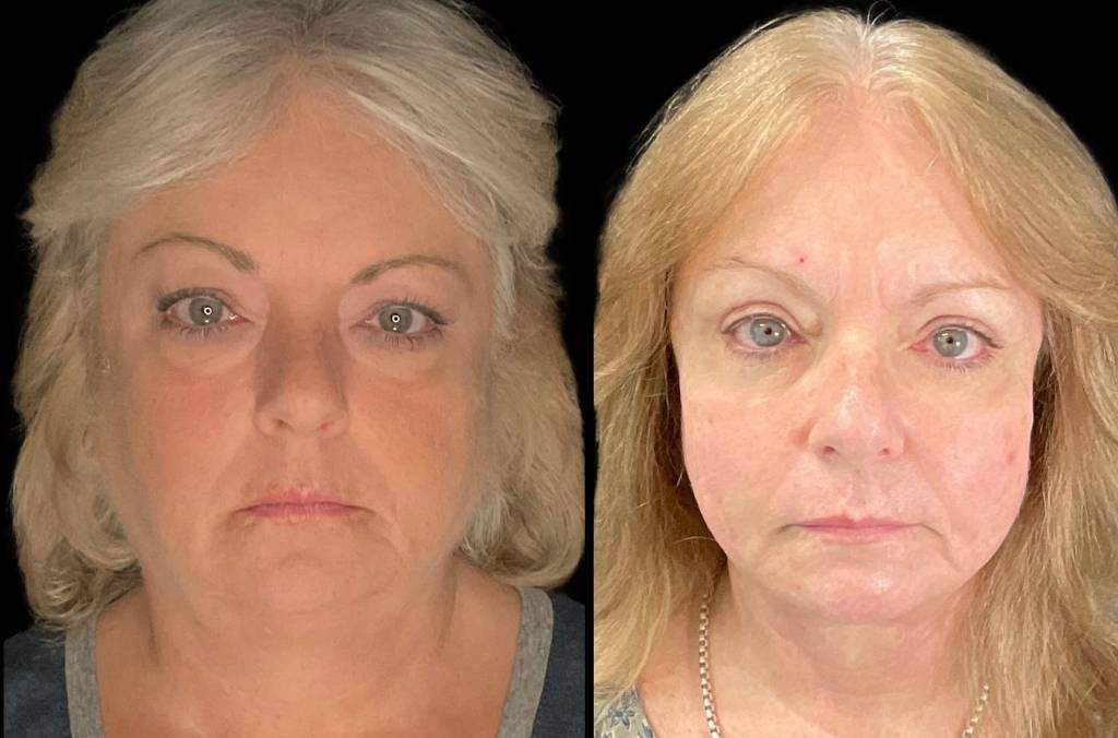 Facelift-61-yr-old-female-before-and-after-front-view.jpg