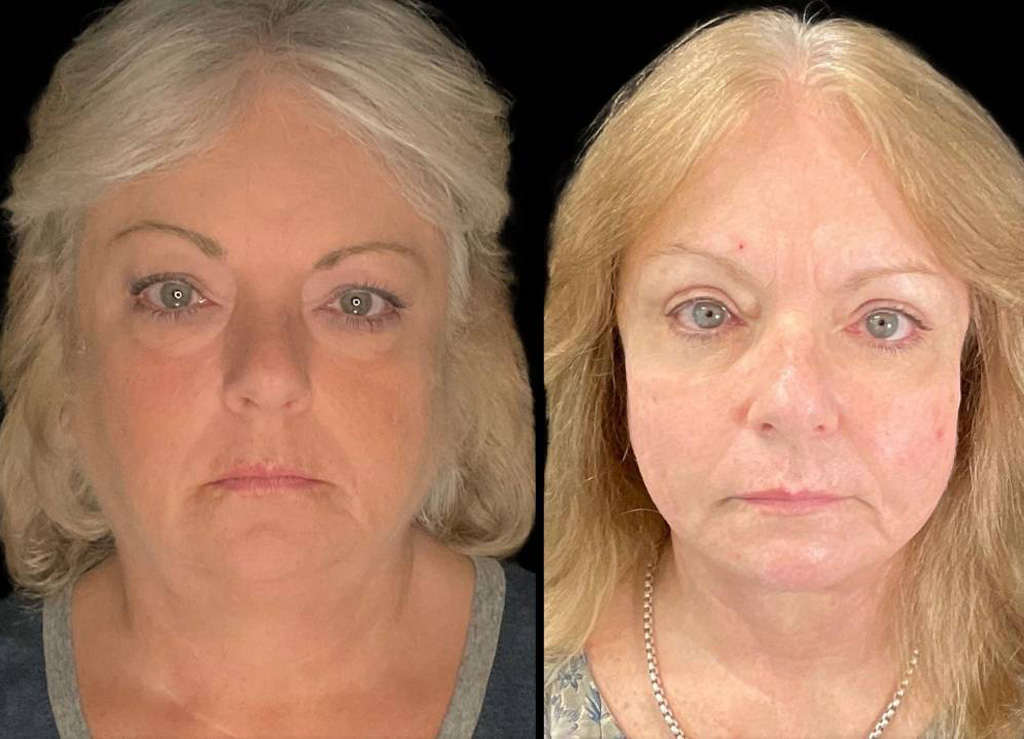 Facelift-61-yr-old-female-before-and-after-front-view.jpg