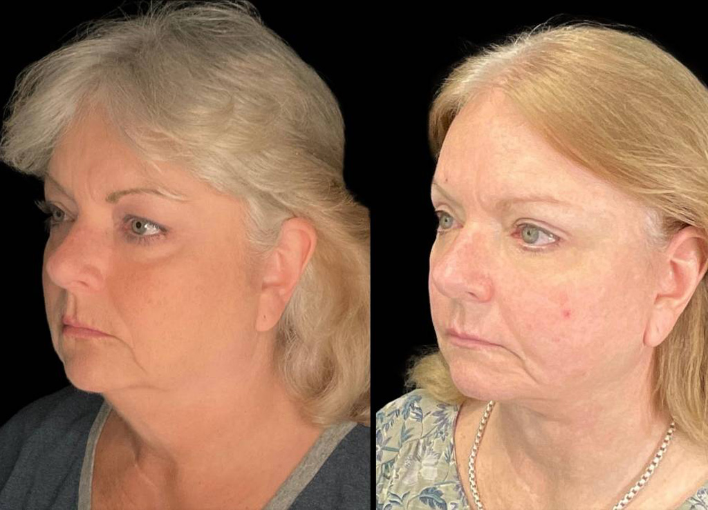 Facelift-61-yr-old-female-before-and-after-left-three-quarter-view.jpg