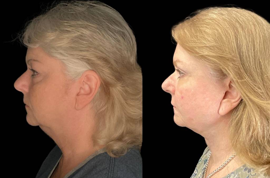 Facelift-61-yr-old-female-before-and-after-left-view.jpg