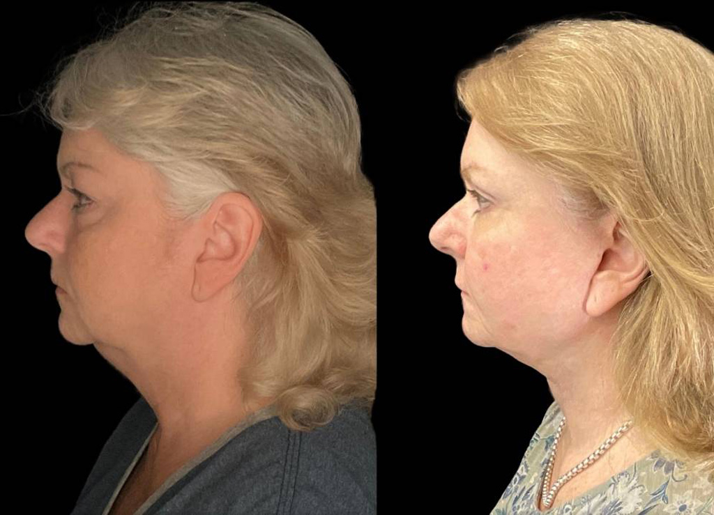 Facelift-61-yr-old-female-before-and-after-left-view.jpg