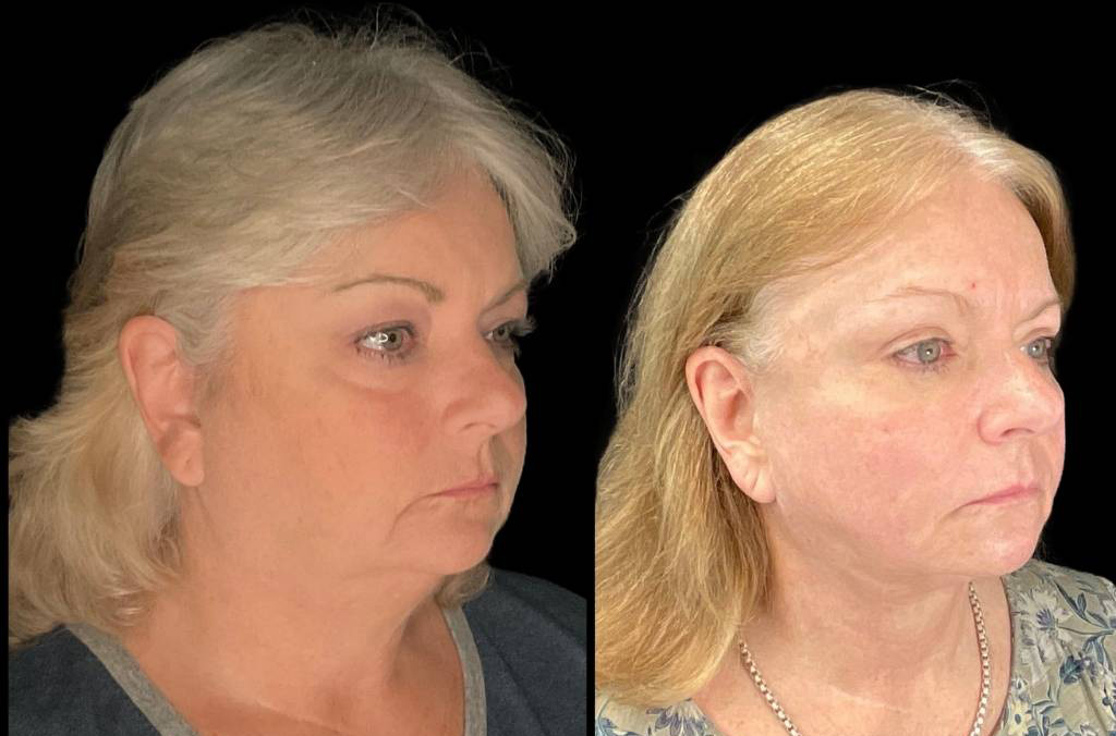 Facelift-61-yr-old-female-before-and-after-right-three-quarter-view.jpg