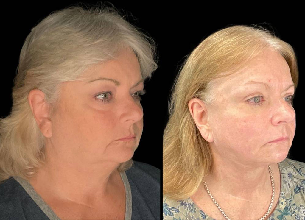Facelift-61-yr-old-female-before-and-after-right-three-quarter-view.jpg