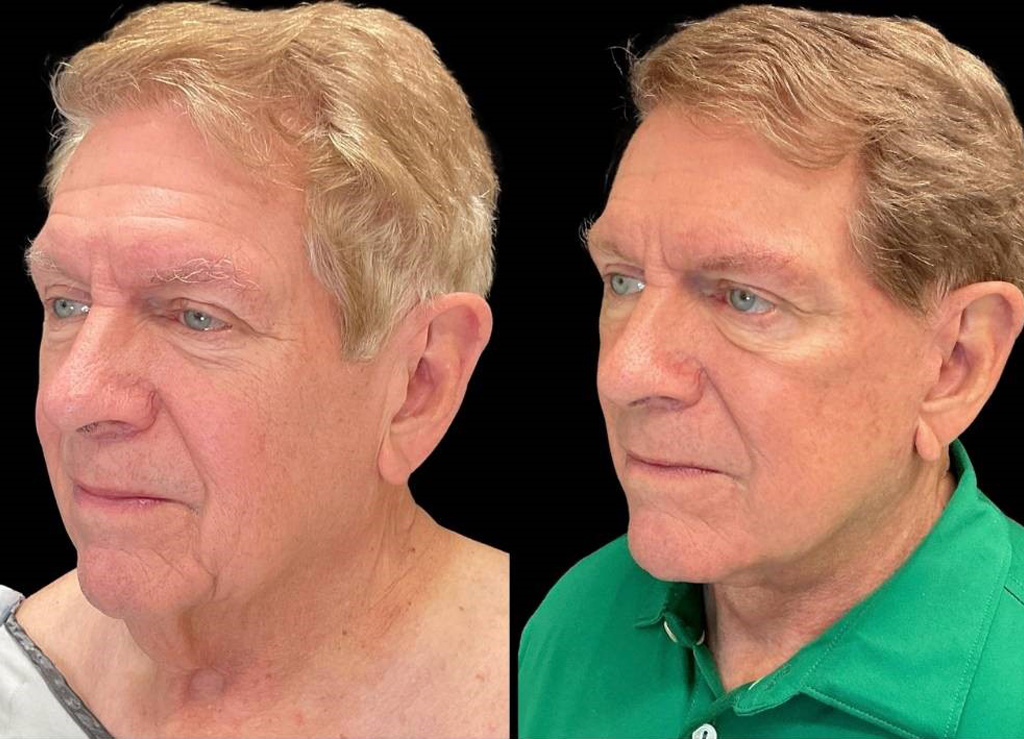 Facelift-75-yr-old-male-before-and-after-left-three-quarter-view-1.jpg