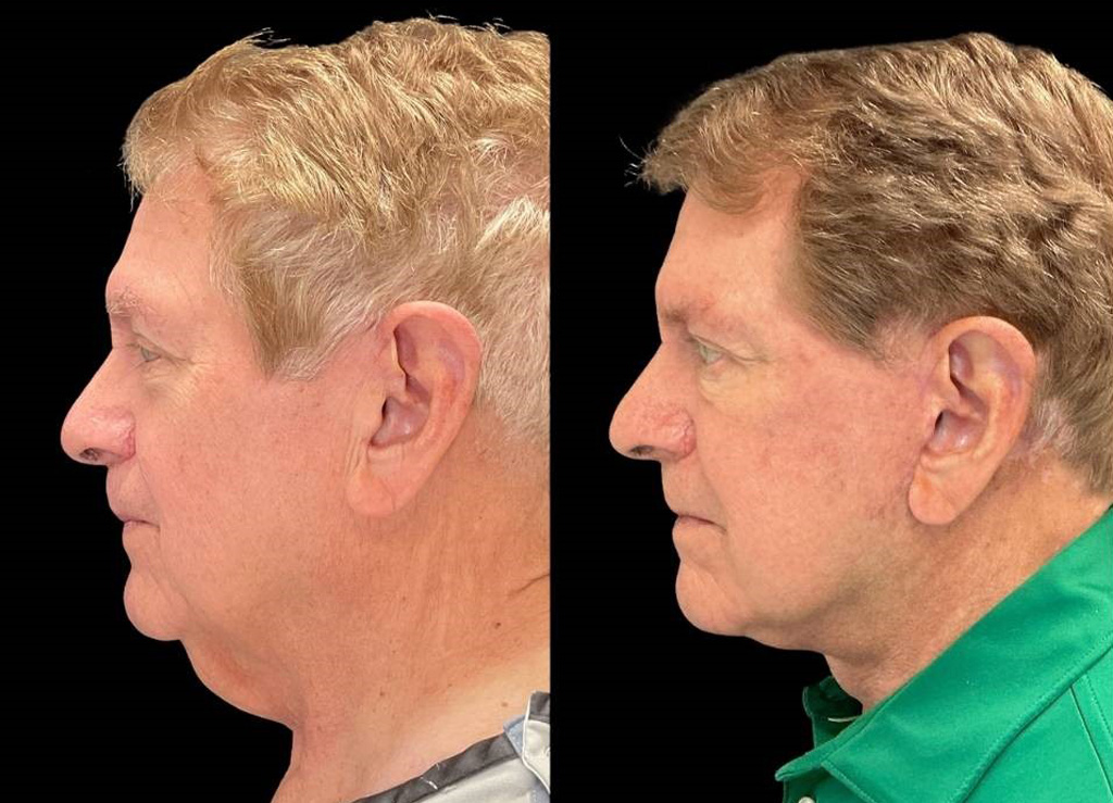 Facelift-75-yr-old-male-before-and-after-left-view-1.jpg