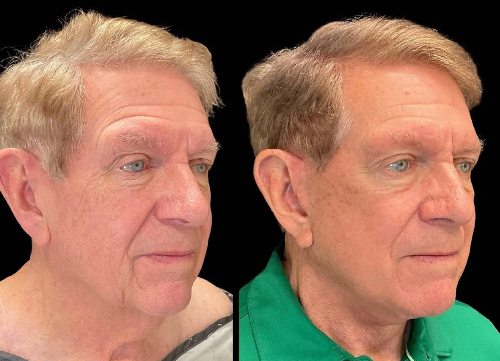 Facelift-75-yr-old-male-before-and-after-right-three-quarter-view.jpg