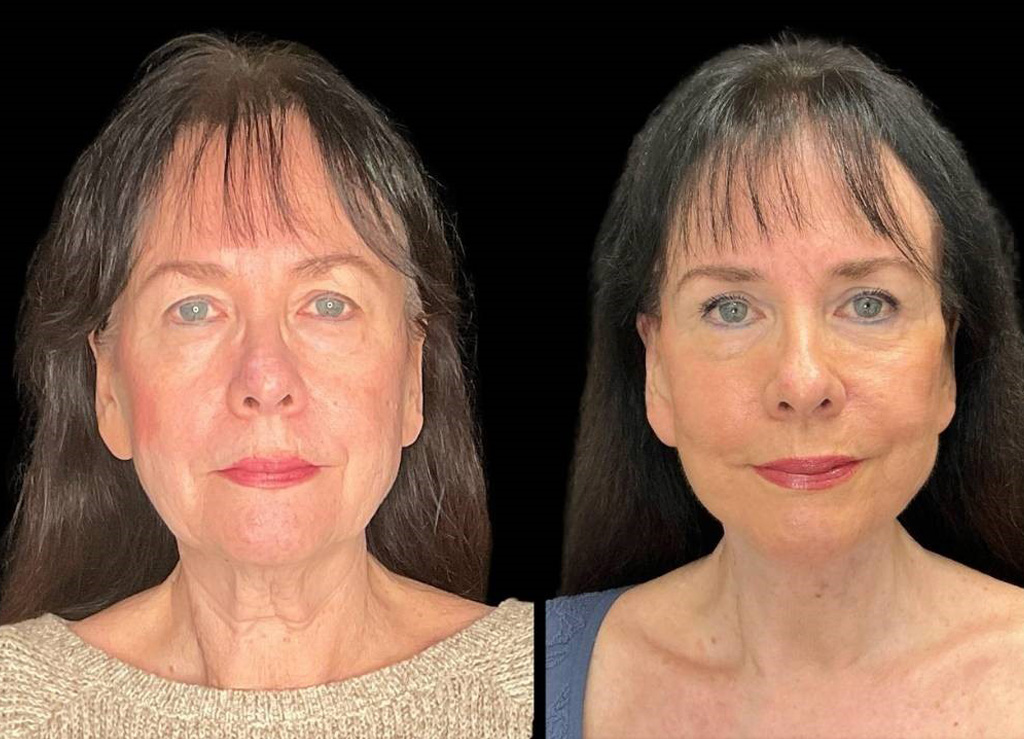 Facelift-Browpexy-Upper-Lower-Eyelid-Lift-Laser-70-yr-old-Female-Before-and-After-Front-View.jpg