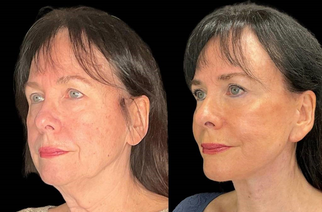 Facelift-Browpexy-Upper-Lower-Eyelid-Lift-Laser-70-yr-old-Female-Before-and-After-Left-Three-Quarter-View.jpg