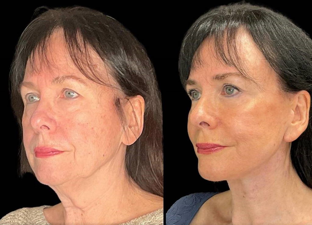 Facelift-Browpexy-Upper-Lower-Eyelid-Lift-Laser-70-yr-old-Female-Before-and-After-Left-Three-Quarter-View.jpg