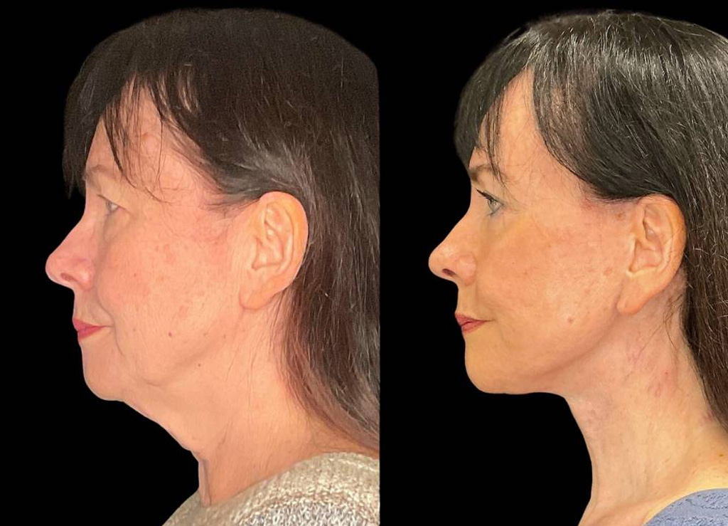 Facelift-Browpexy-Upper-Lower-Eyelid-Lift-Laser-70-yr-old-Female-Before-and-After-Left-View.jpg