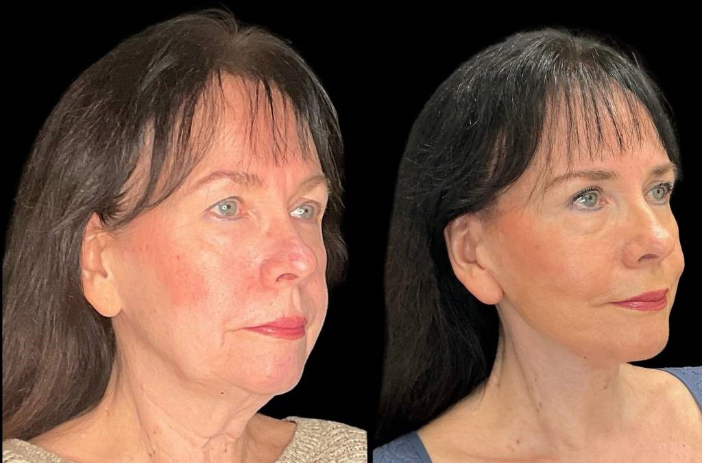 Facelift-Browpexy-Upper-Lower-Eyelid-Lift-Laser-70-yr-old-Female-Before-and-After-Right-Three-Quarter-View.jpg