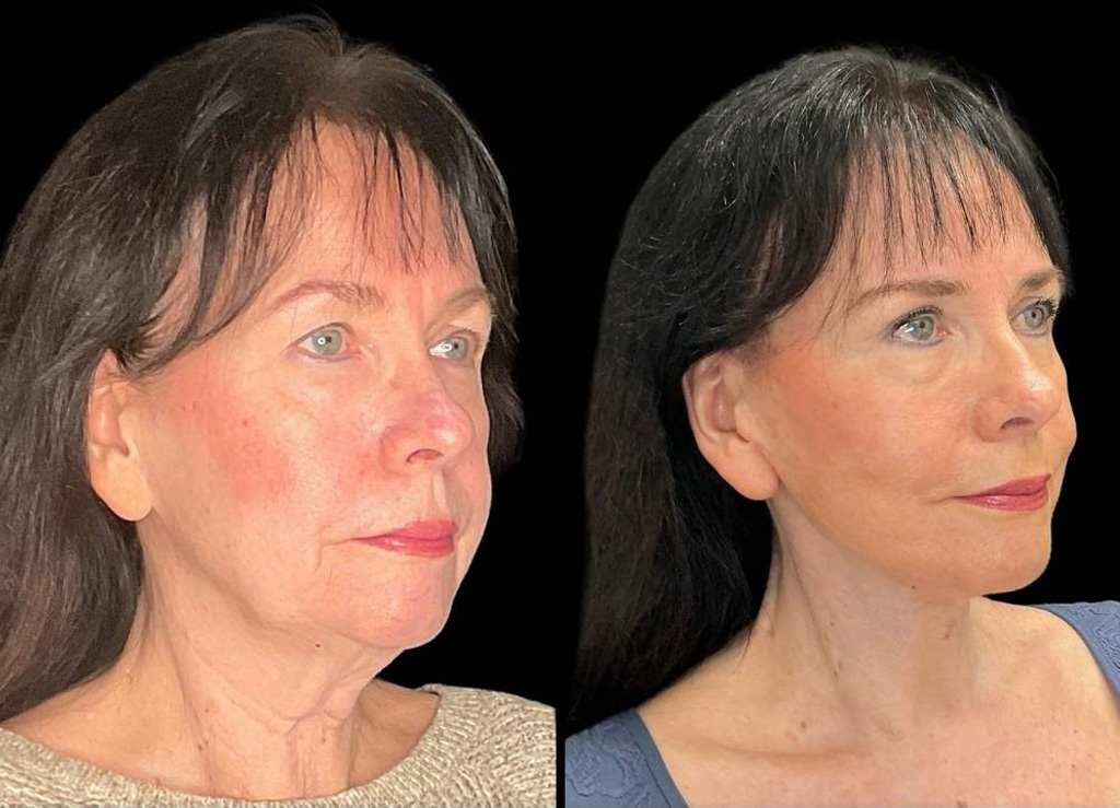 Facelift-Browpexy-Upper-Lower-Eyelid-Lift-Laser-70-yr-old-Female-Before-and-After-Right-Three-Quarter-View.jpg