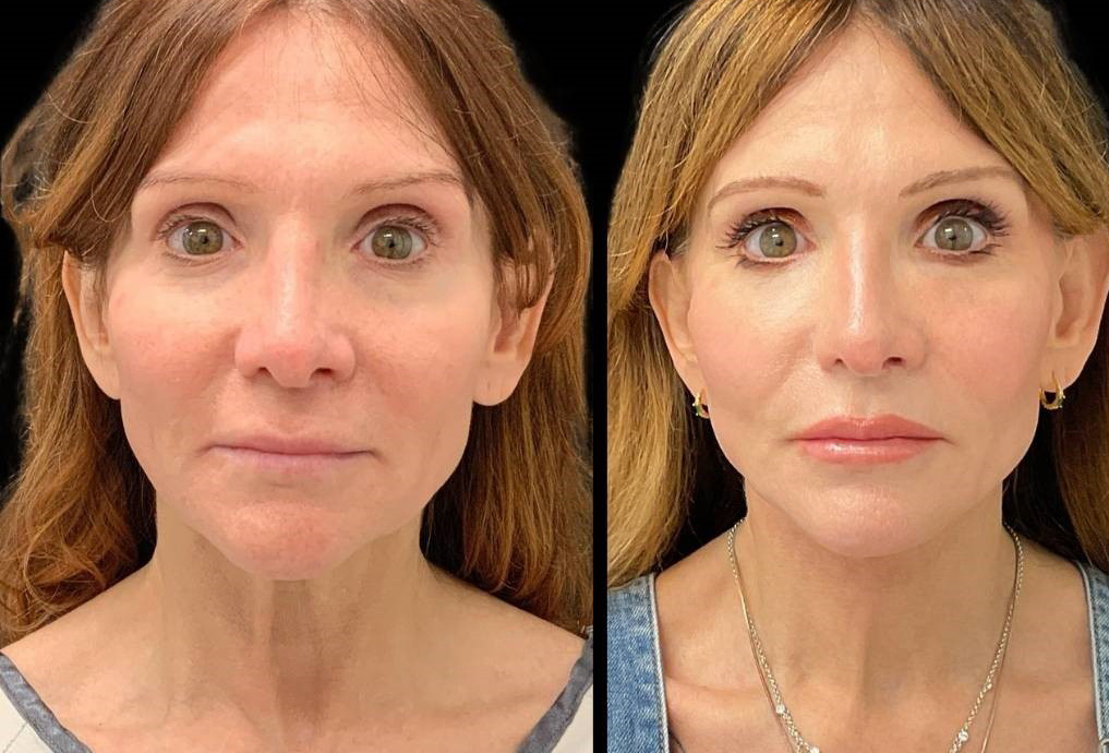 Facelift-Fat-Grafting-Upper-Lower-Eyelid-Lift-Browpexy-Laser-56-yr-old-female-before-and-after-front-view.jpg