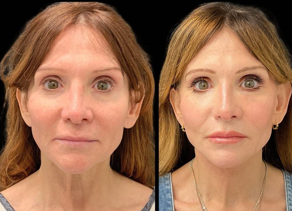 Facelift-Fat-Grafting-Upper-Lower-Eyelid-Lift-Browpexy-Laser-56-yr-old-female-before-and-after-front-view.jpg