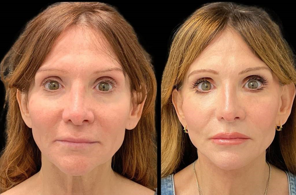 Facelift-Fat-Grafting-Upper-Lower-Eyelid-Lift-Browpexy-Laser-56-yr-old-female-before-and-after-front-view.jpg