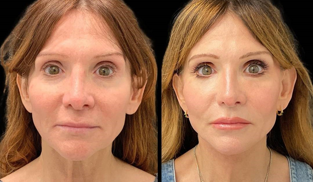 Facelift-Fat-Grafting-Upper-Lower-Eyelid-Lift-Browpexy-Laser-56-yr-old-female-before-and-after-front-view.jpg