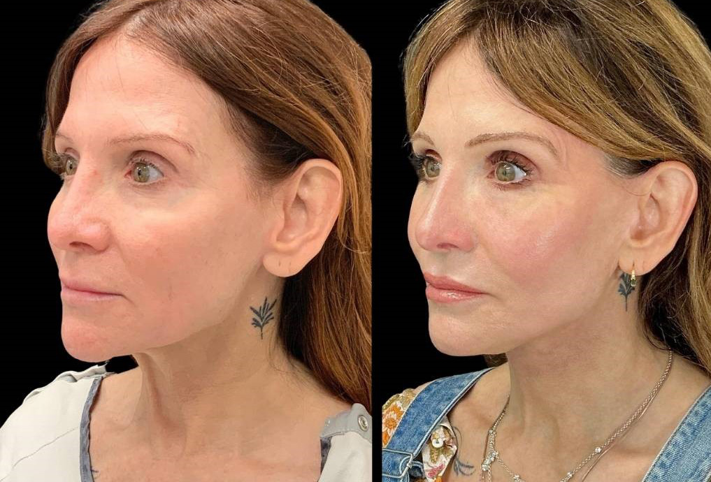 Facelift-Fat-Grafting-Upper-Lower-Eyelid-Lift-Browpexy-Laser-56-yr-old-female-before-and-after-left-three-quarter-view.jpg
