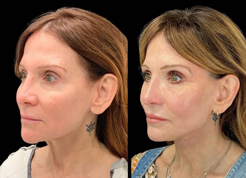 Facelift-Fat-Grafting-Upper-Lower-Eyelid-Lift-Browpexy-Laser-56-yr-old-female-before-and-after-left-three-quarter-view.jpg