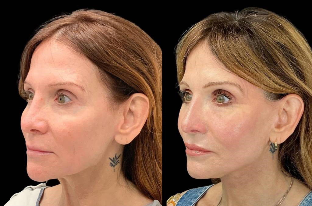 Facelift-Fat-Grafting-Upper-Lower-Eyelid-Lift-Browpexy-Laser-56-yr-old-female-before-and-after-left-three-quarter-view.jpg