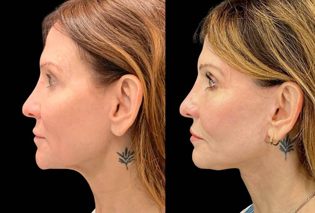 Facelift-Fat-Grafting-Upper-Lower-Eyelid-Lift-Browpexy-Laser-56-yr-old-female-before-and-after-left-view.jpg