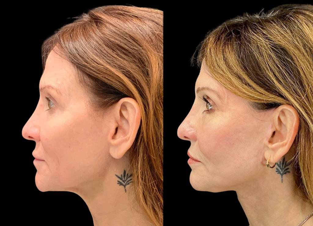 Facelift-Fat-Grafting-Upper-Lower-Eyelid-Lift-Browpexy-Laser-56-yr-old-female-before-and-after-left-view.jpg