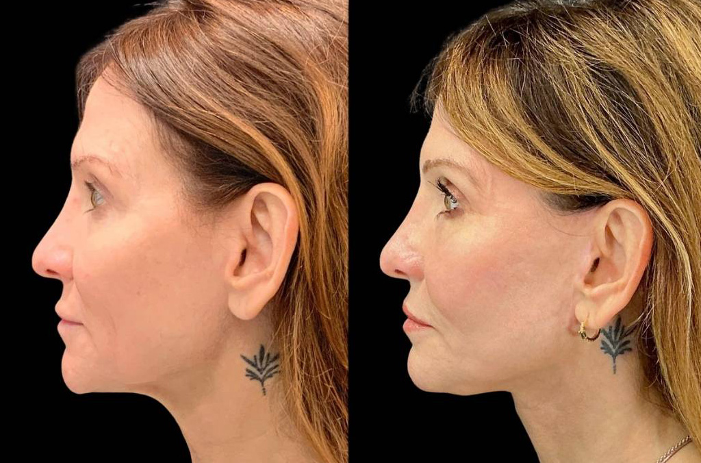 Facelift-Fat-Grafting-Upper-Lower-Eyelid-Lift-Browpexy-Laser-56-yr-old-female-before-and-after-left-view.jpg