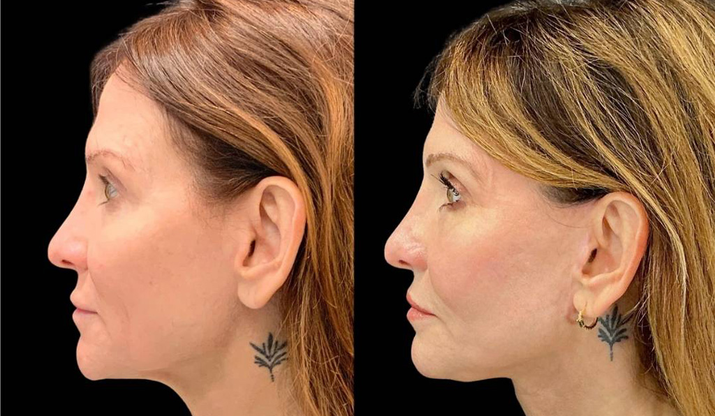 Facelift-Fat-Grafting-Upper-Lower-Eyelid-Lift-Browpexy-Laser-56-yr-old-female-before-and-after-left-view.jpg