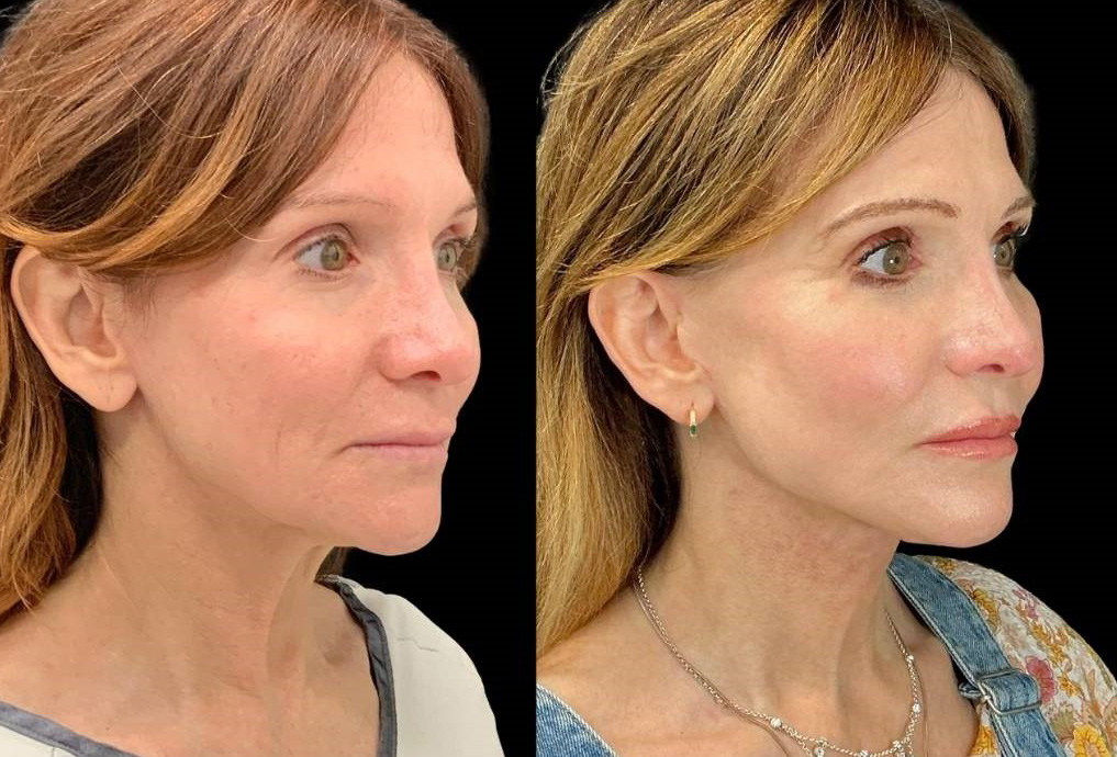 Facelift-Fat-Grafting-Upper-Lower-Eyelid-Lift-Browpexy-Laser-56-yr-old-female-before-and-after-right-three-quarter-view.jpg