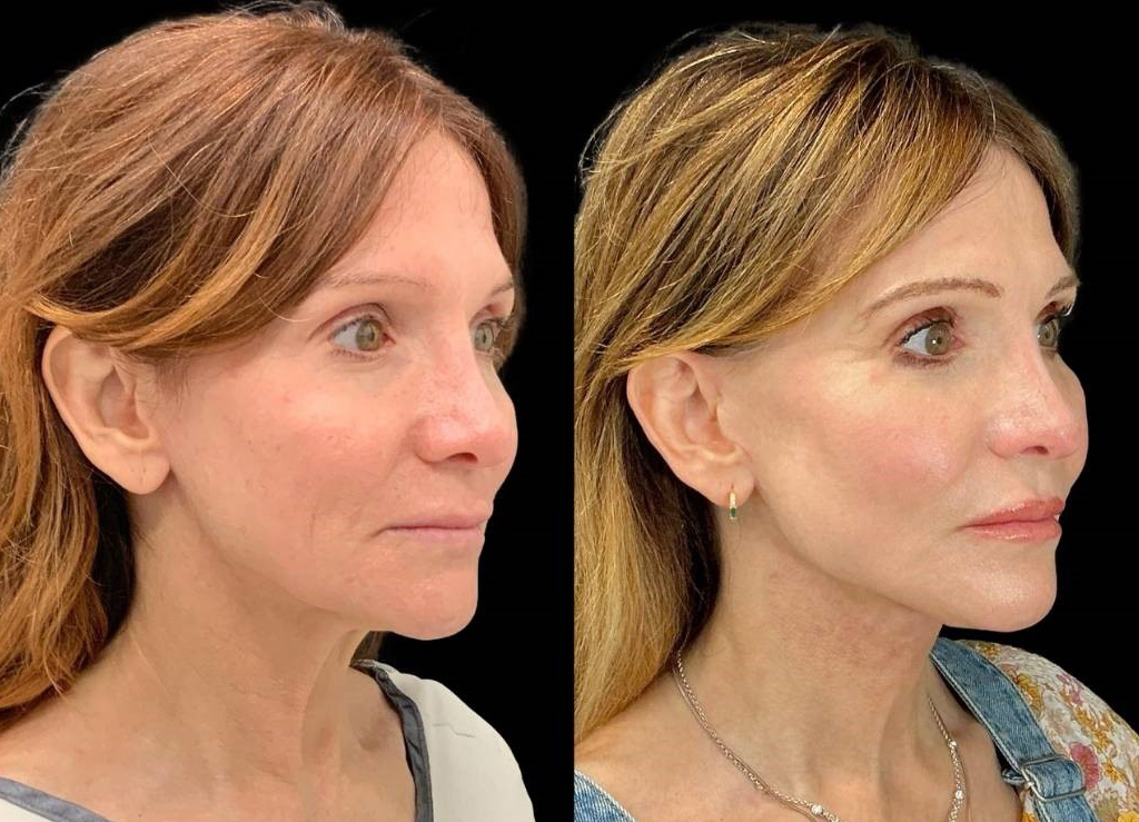 Facelift-Fat-Grafting-Upper-Lower-Eyelid-Lift-Browpexy-Laser-56-yr-old-female-before-and-after-right-three-quarter-view.jpg