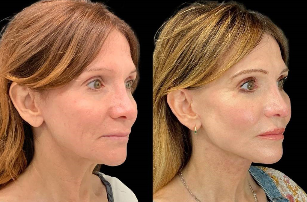 Facelift-Fat-Grafting-Upper-Lower-Eyelid-Lift-Browpexy-Laser-56-yr-old-female-before-and-after-right-three-quarter-view.jpg