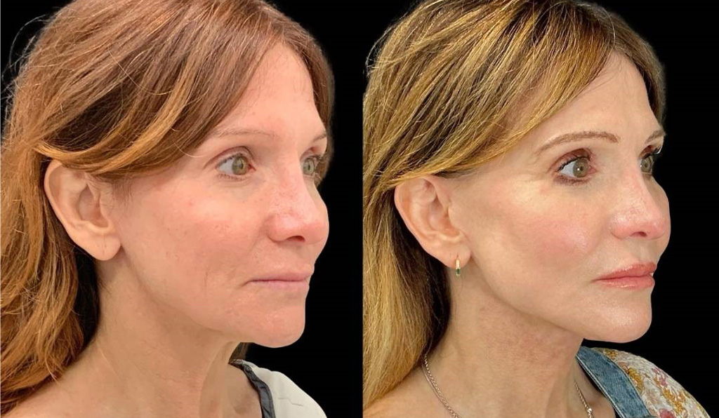 Facelift-Fat-Grafting-Upper-Lower-Eyelid-Lift-Browpexy-Laser-56-yr-old-female-before-and-after-right-three-quarter-view.jpg
