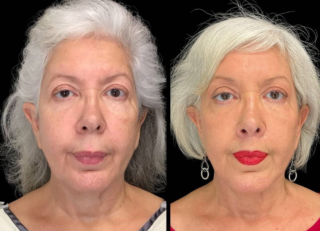 Facelift-Forehead-Lift-Upper-Lip-Lift-Laser-64-yr-old-female-before-and-after-front-view.jpg