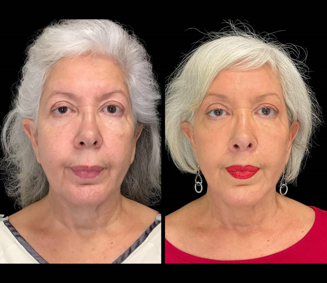 Facelift-Forehead-Lift-Upper-Lip-Lift-Laser-64-yr-old-female-before-and-after-front-view.jpg