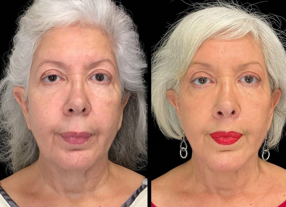 Facelift-Forehead-Lift-Upper-Lip-Lift-Laser-64-yr-old-female-before-and-after-front-view.jpg