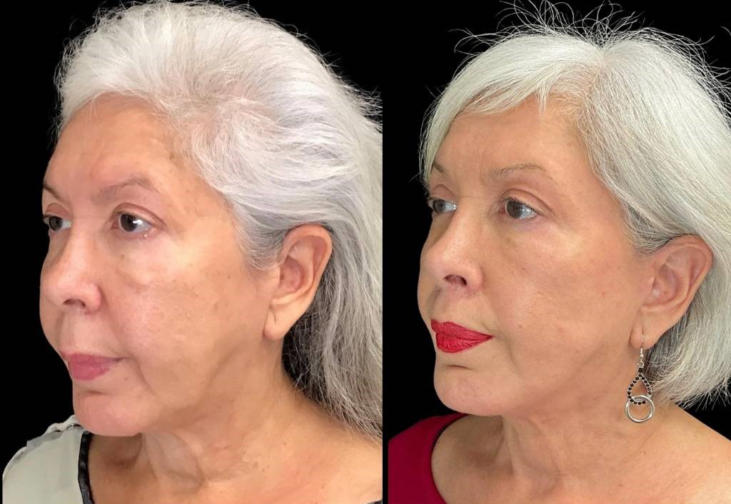 Facelift-Forehead-Lift-Upper-Lip-Lift-Laser-64-yr-old-female-before-and-after-left-three-quarter-view.jpg