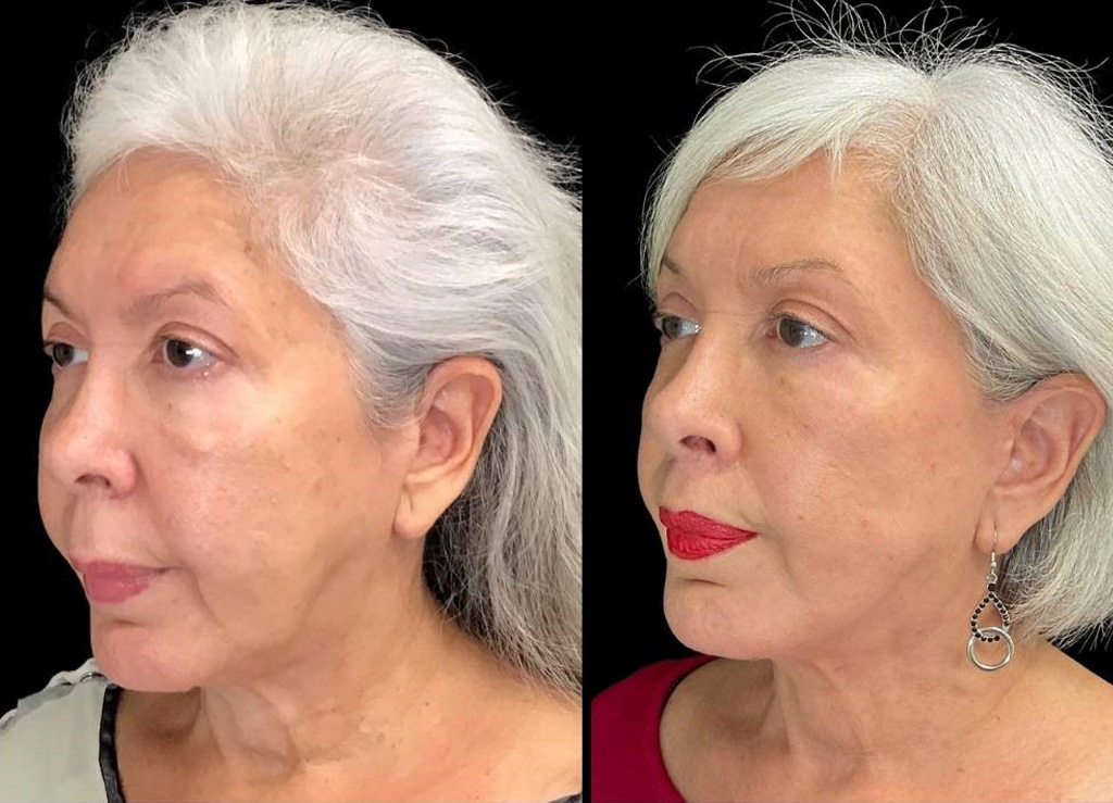 Facelift-Forehead-Lift-Upper-Lip-Lift-Laser-64-yr-old-female-before-and-after-left-three-quarter-view.jpg
