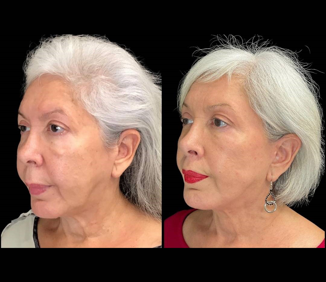 Facelift-Forehead-Lift-Upper-Lip-Lift-Laser-64-yr-old-female-before-and-after-left-three-quarter-view.jpg