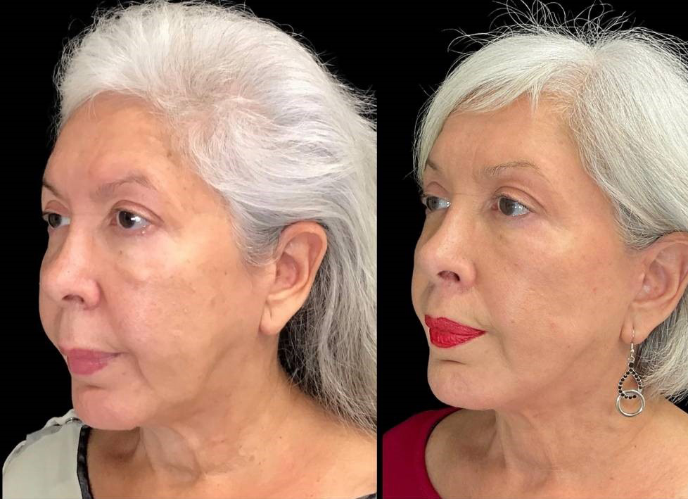 Facelift-Forehead-Lift-Upper-Lip-Lift-Laser-64-yr-old-female-before-and-after-left-three-quarter-view.jpg