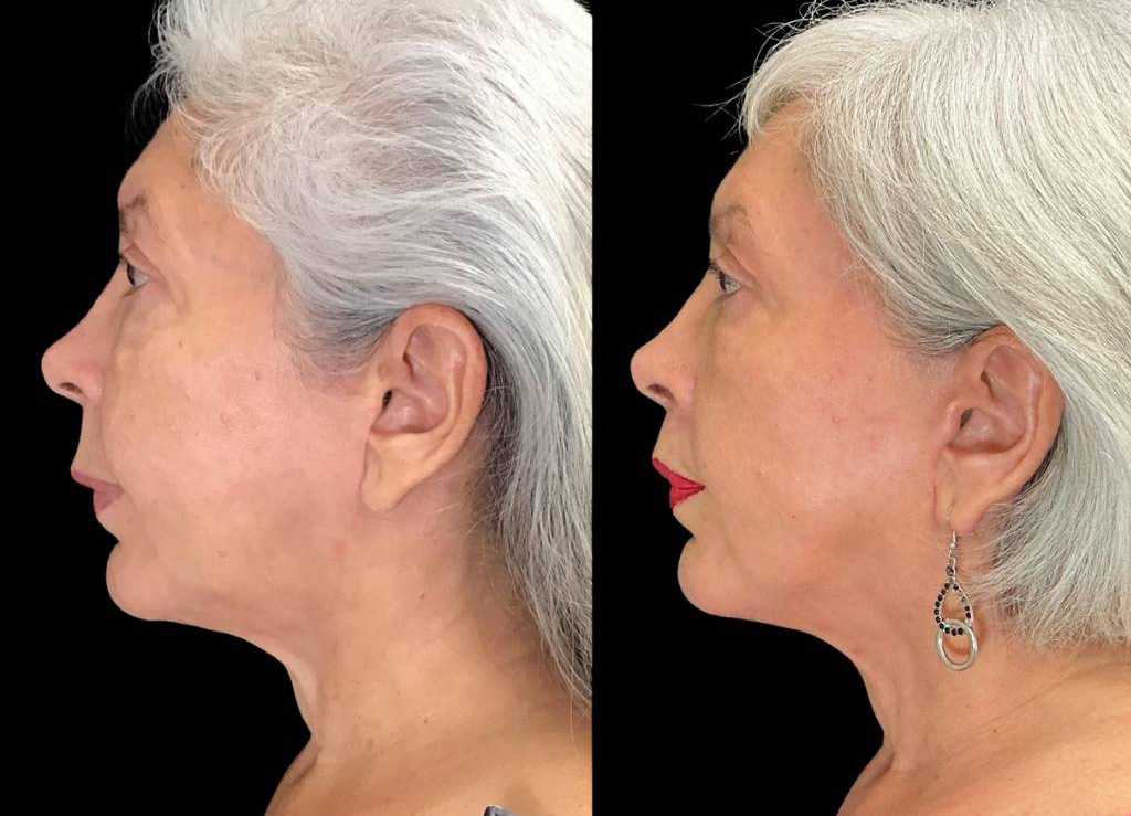 Facelift-Forehead-Lift-Upper-Lip-Lift-Laser-64-yr-old-female-before-and-after-left-view.jpg