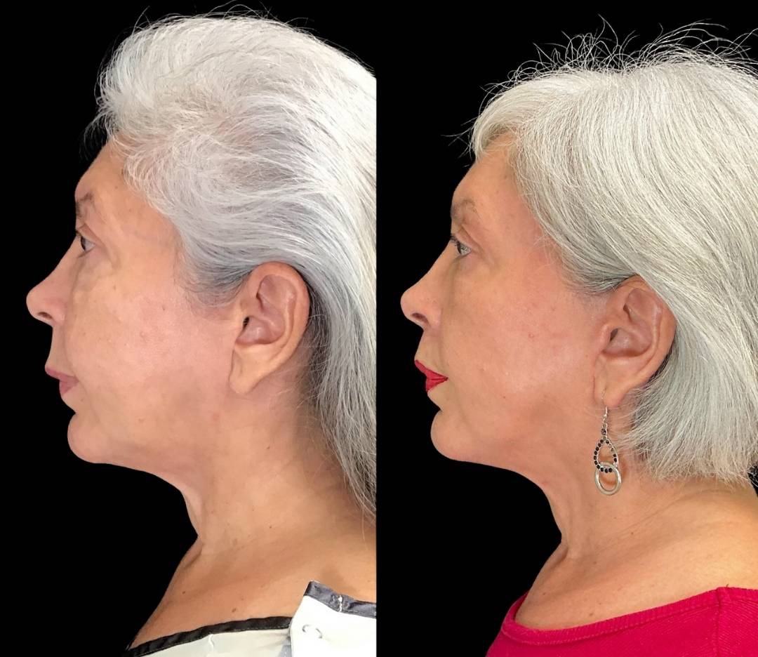 Facelift-Forehead-Lift-Upper-Lip-Lift-Laser-64-yr-old-female-before-and-after-left-view.jpg