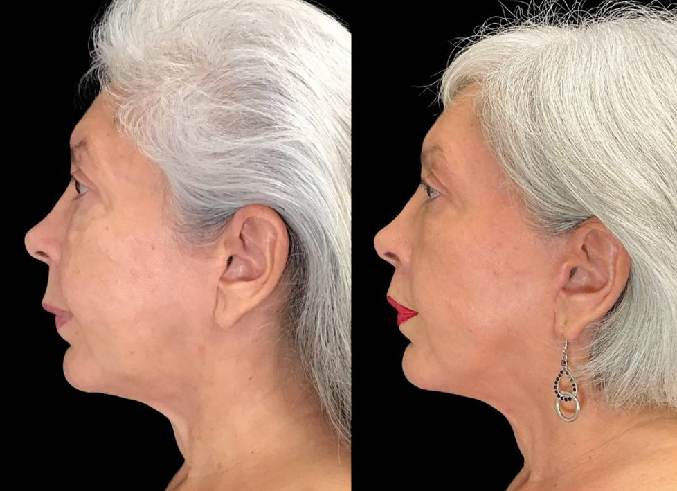 Facelift-Forehead-Lift-Upper-Lip-Lift-Laser-64-yr-old-female-before-and-after-left-view.jpg