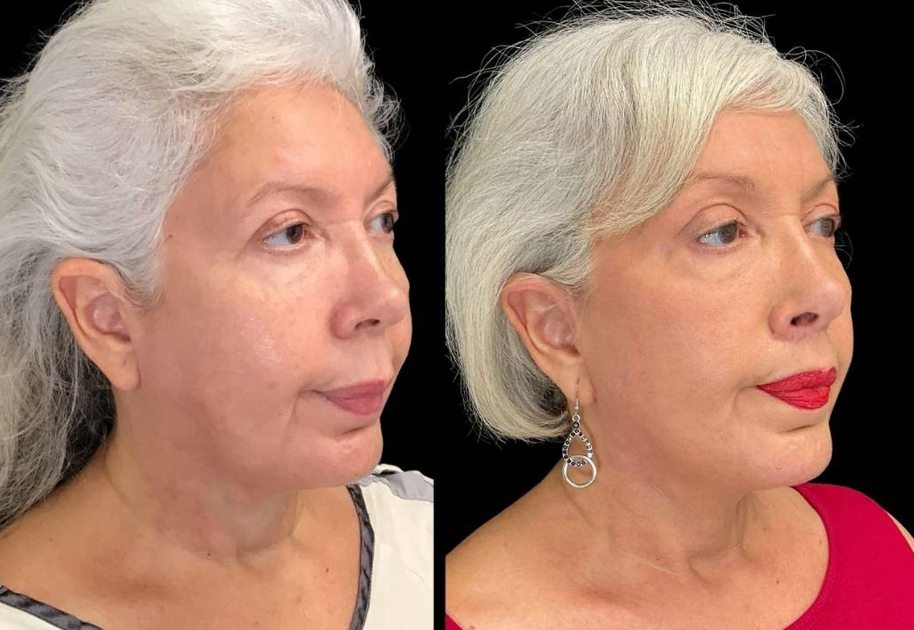 Facelift-Forehead-Lift-Upper-Lip-Lift-Laser-64-yr-old-female-before-and-after-right-three-quarter-view.jpg