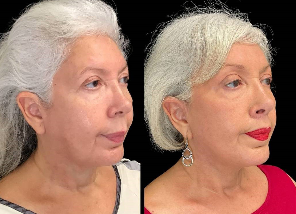 Facelift-Forehead-Lift-Upper-Lip-Lift-Laser-64-yr-old-female-before-and-after-right-three-quarter-view.jpg