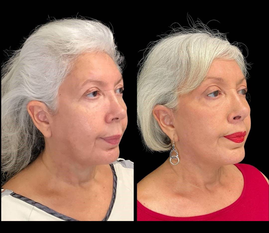Facelift-Forehead-Lift-Upper-Lip-Lift-Laser-64-yr-old-female-before-and-after-right-three-quarter-view.jpg