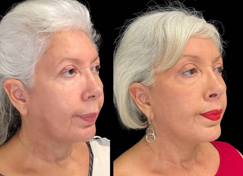 Facelift-Forehead-Lift-Upper-Lip-Lift-Laser-64-yr-old-female-before-and-after-right-three-quarter-view.jpg